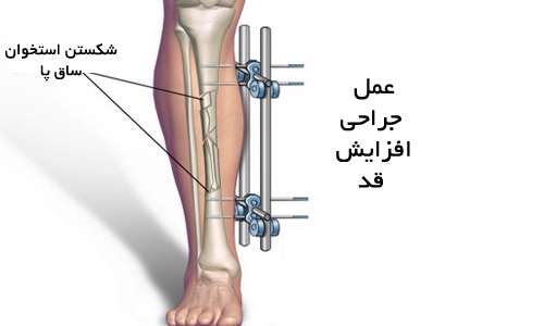 جراحی افزایش قد