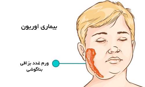 بیماری اوریون