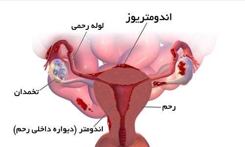 درد قاعدگی بعد از روز سوم را جدی بگیرید درد قاعدگی بعد از روز سوم را جدی بگیرید