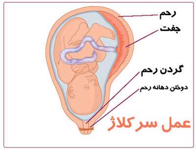 سرکلاژ