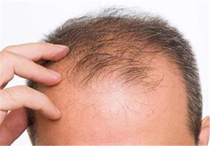 اشتباهاتی که باعث ریزش مو میشود اشتباهاتی که باعث ریزش مو میشود