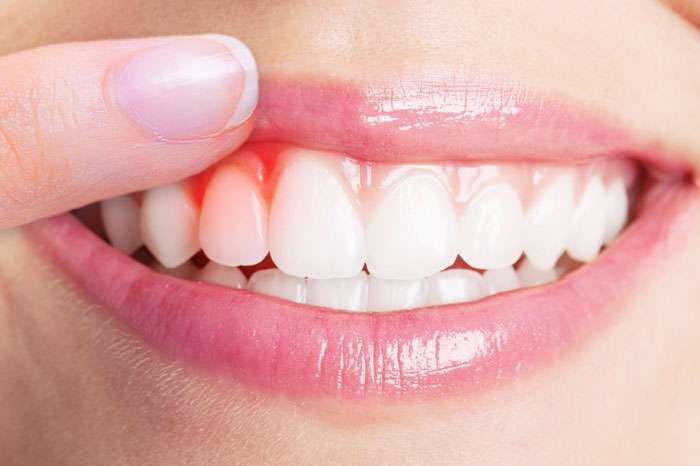 لثهها به 6 دلیل دچار خونریزی میشوند لثهها به 6 دلیل دچار خونریزی میشوند