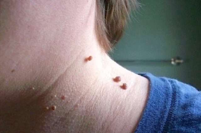 منگوله های گوشتی