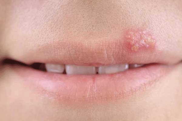 زخم های کوچک و خطرناکی به اسم تب خال زخم های کوچک و خطرناکی به اسم تب خال