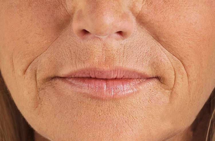 خط خنده را چگونه از بین ببریم؟ خط خنده را چگونه از بین ببریم؟