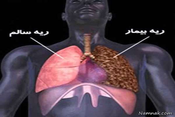 کیت تشخیص زود هنگام سرطان ریه با روش رنگ سنجی