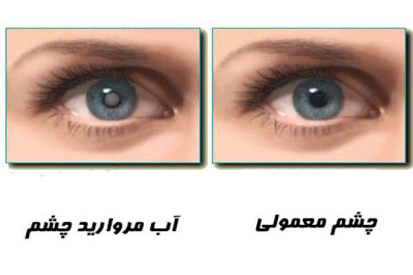باز طراحی ابزار جراحی بیماری آب مروارید بر اساس متون پزشکی قرن 4 هجری قمری در تمدن اسلامی