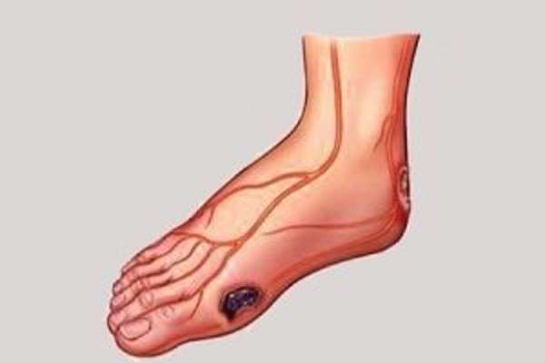 ترمیم زخم دیابت با لایه هیدروژل