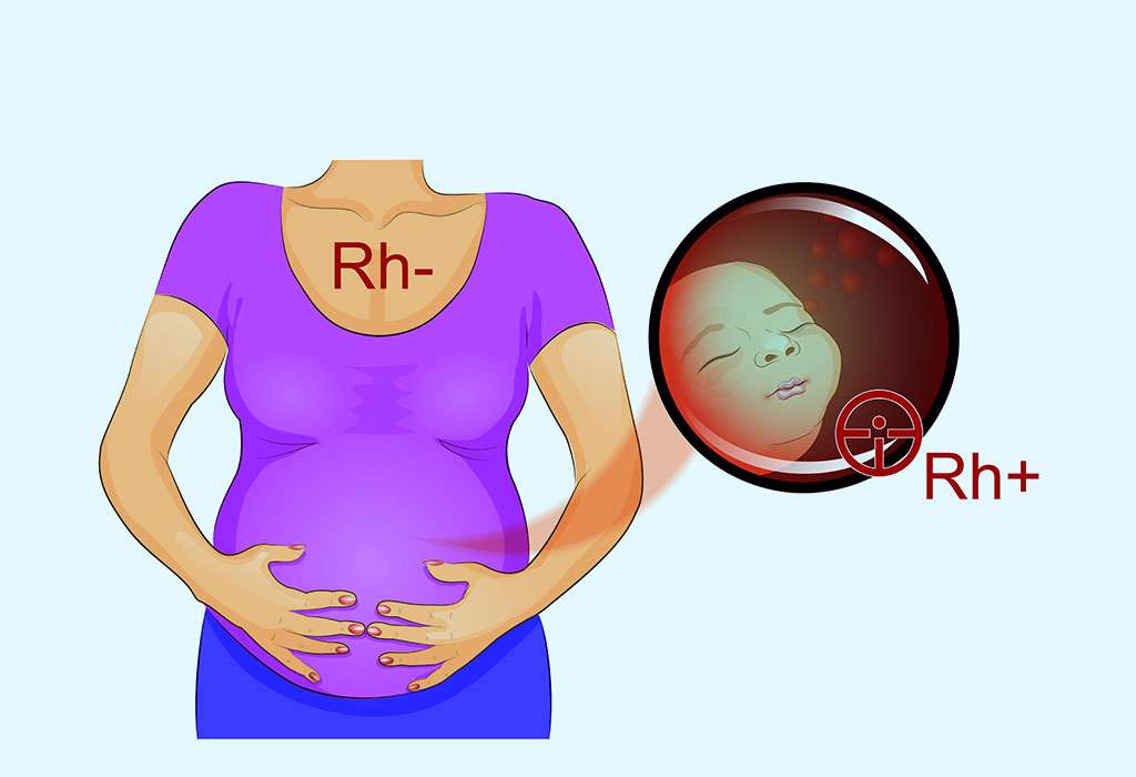یادداشتی درباره نقش عامل Rh در بارداری یادداشتی درباره نقش عامل Rh در بارداری