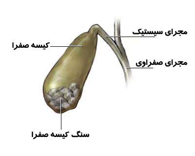 سنگ کیسه صفرا چگونه ایجاد می شود؟ سنگ کیسه صفرا چگونه ایجاد می شود؟