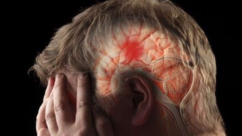 در هر پنج دقیقه یک ایرانی سکته مغزی میکند در هر پنج دقیقه یک ایرانی سکته مغزی میکند
