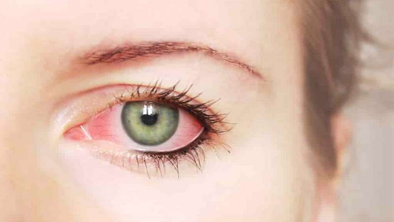 ۵ دلیل احتمالی قرمزی چشمها ۵ دلیل احتمالی قرمزی چشمها