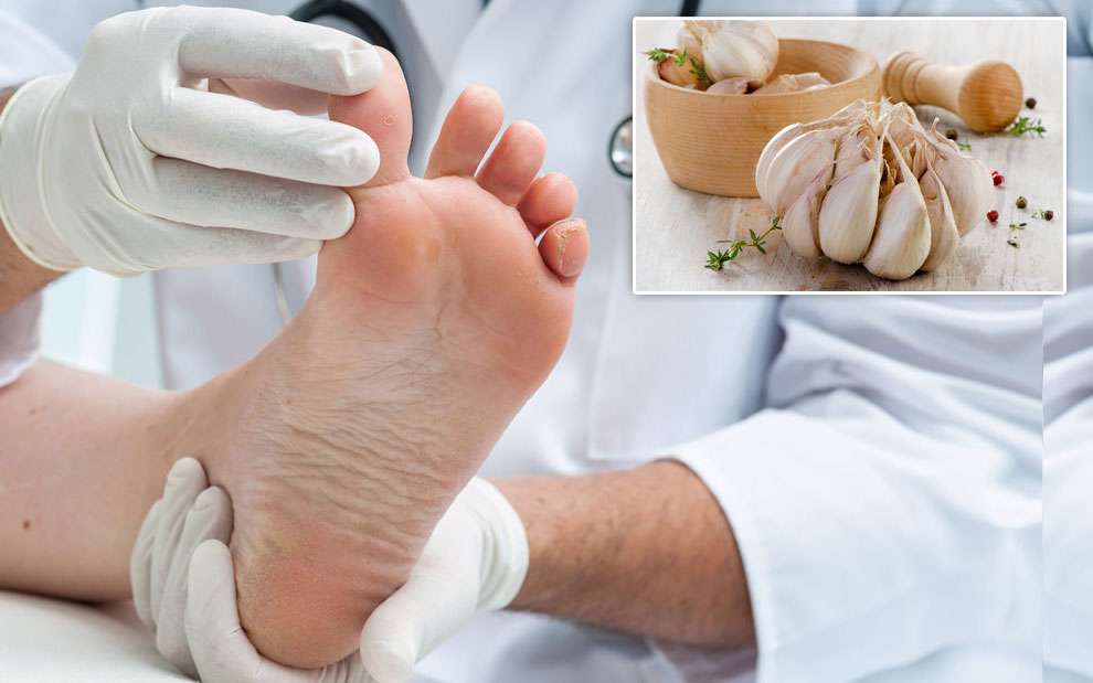 استفاده از سیر برای بیماری پای ورزشکاران