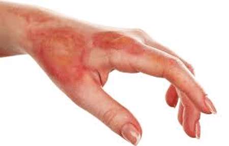 طراحی و ساخت افشانه التیام دهنده سوختگی ناشی از اسید با استفاده از منابع طب سنتی