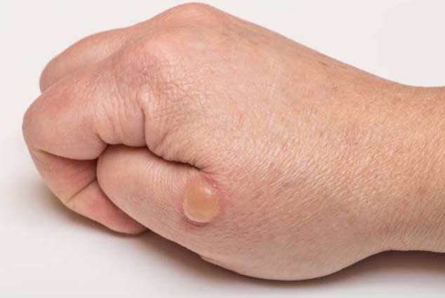 چرا پوستمان تاول میزند؟ چرا پوستمان تاول میزند؟