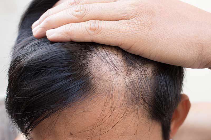 راههای کنار آمدن با ریزش موها راههای کنار آمدن با ریزش موها