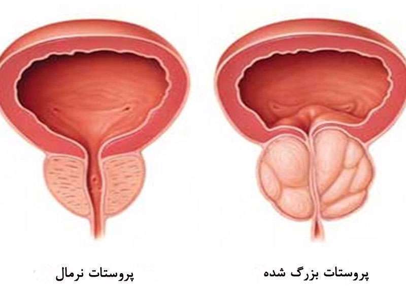 علائم بزرگی پروستات و روش های درمان آن علائم بزرگی پروستات و روش های درمان آن