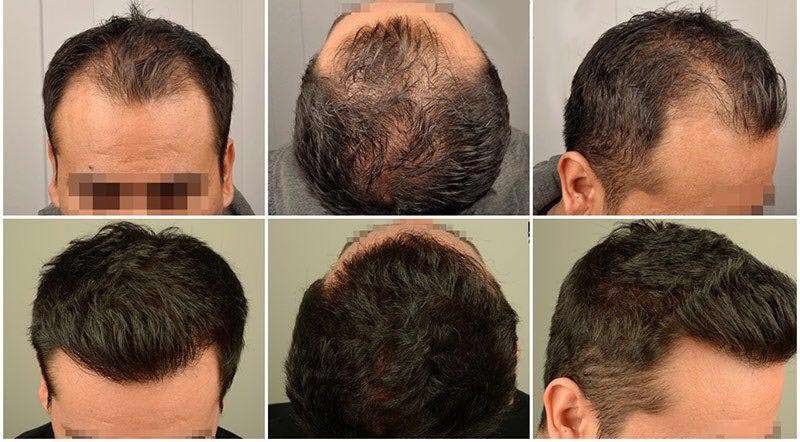 کاشت مو