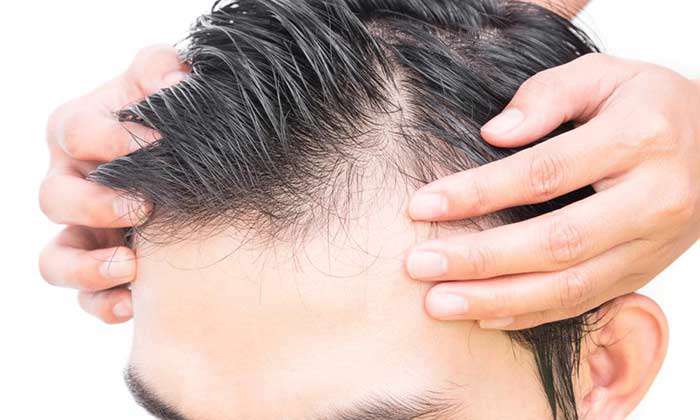 الگوی طاسی مردانه و درمان با دارو، تزریق prp و کاشت موی طبیعی