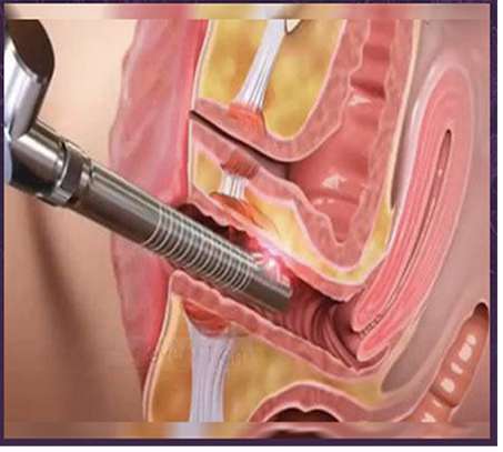 لیزر درمانی فیستول و دیگر ضایعات مقعدی