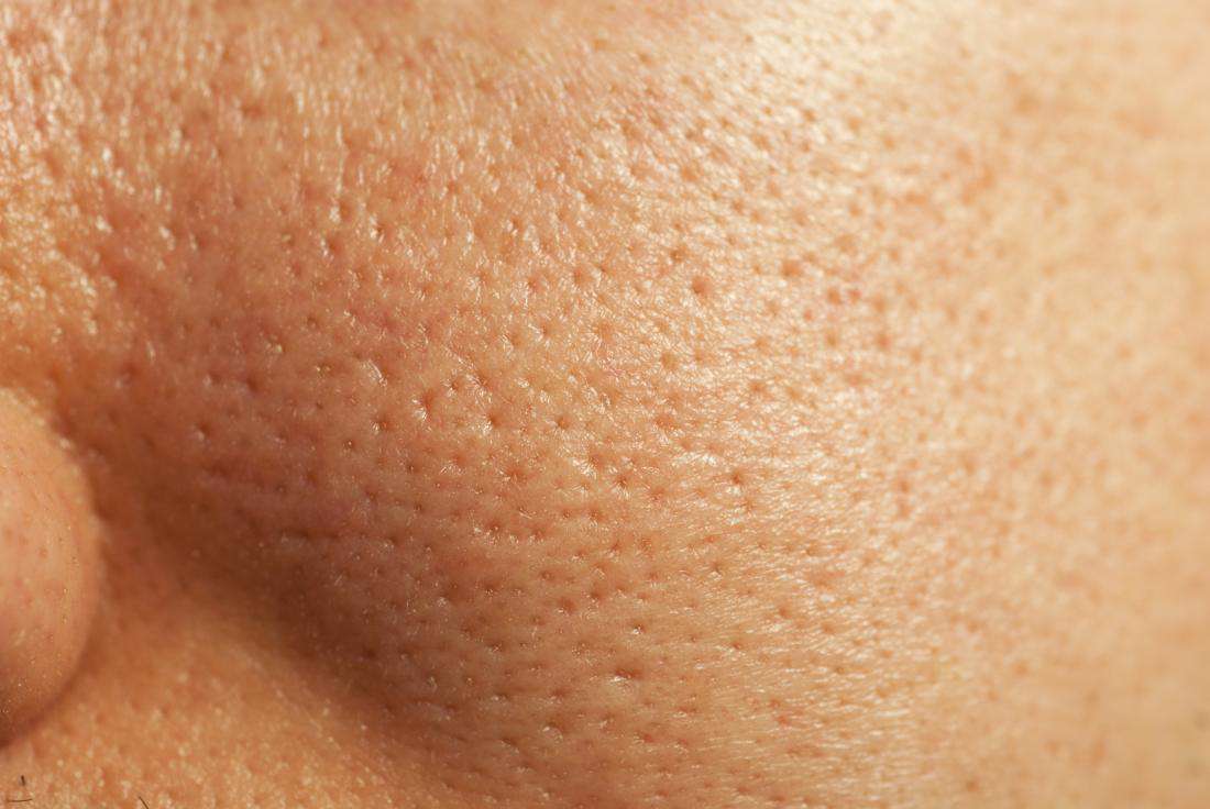 راست و دروغهای منافذ پوستی راست و دروغهای منافذ پوستی