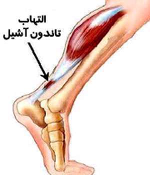 التهاب تاندون آشیل