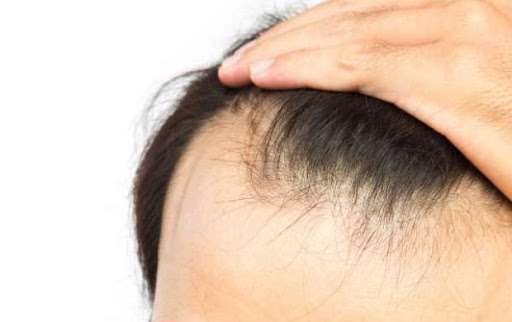 راه های جلوگیری از ریزش مو راه های جلوگیری از ریزش مو