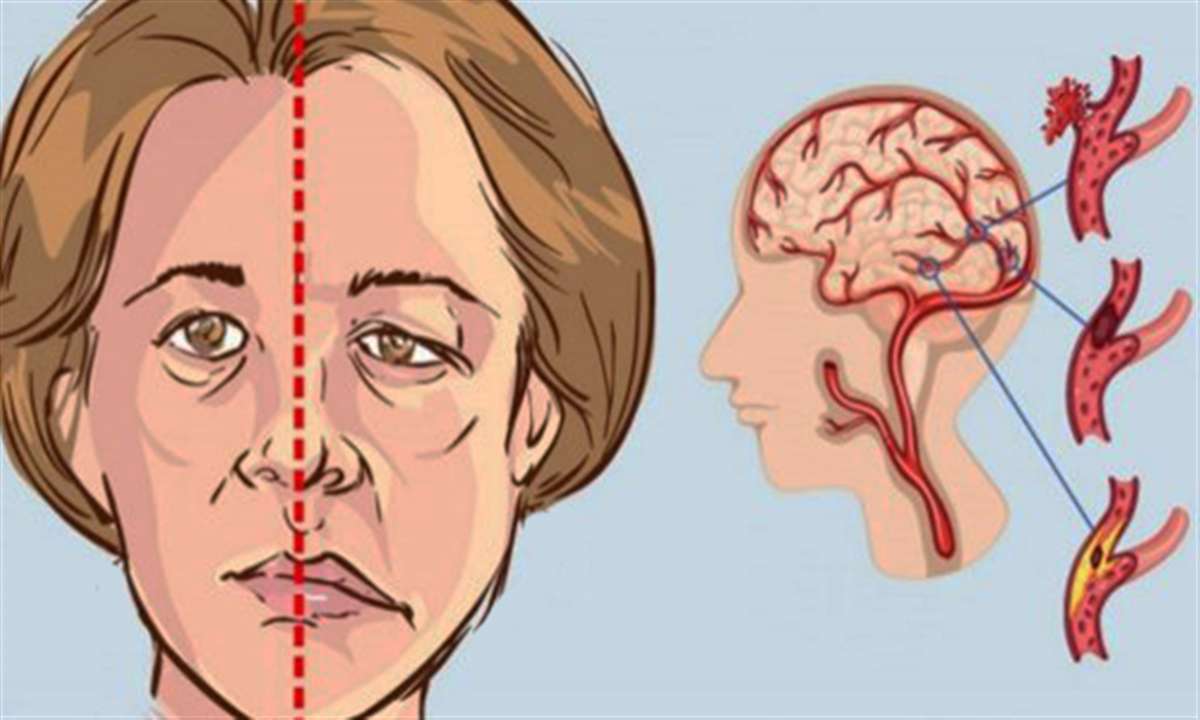 سکته مغزی، بیماری قلب و عروق، سکته،