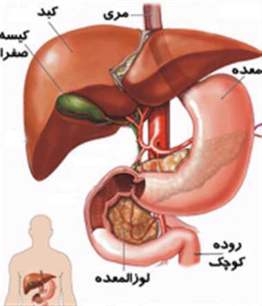 التهاب کیسه صفرا، سنگ کیسه صفرا،