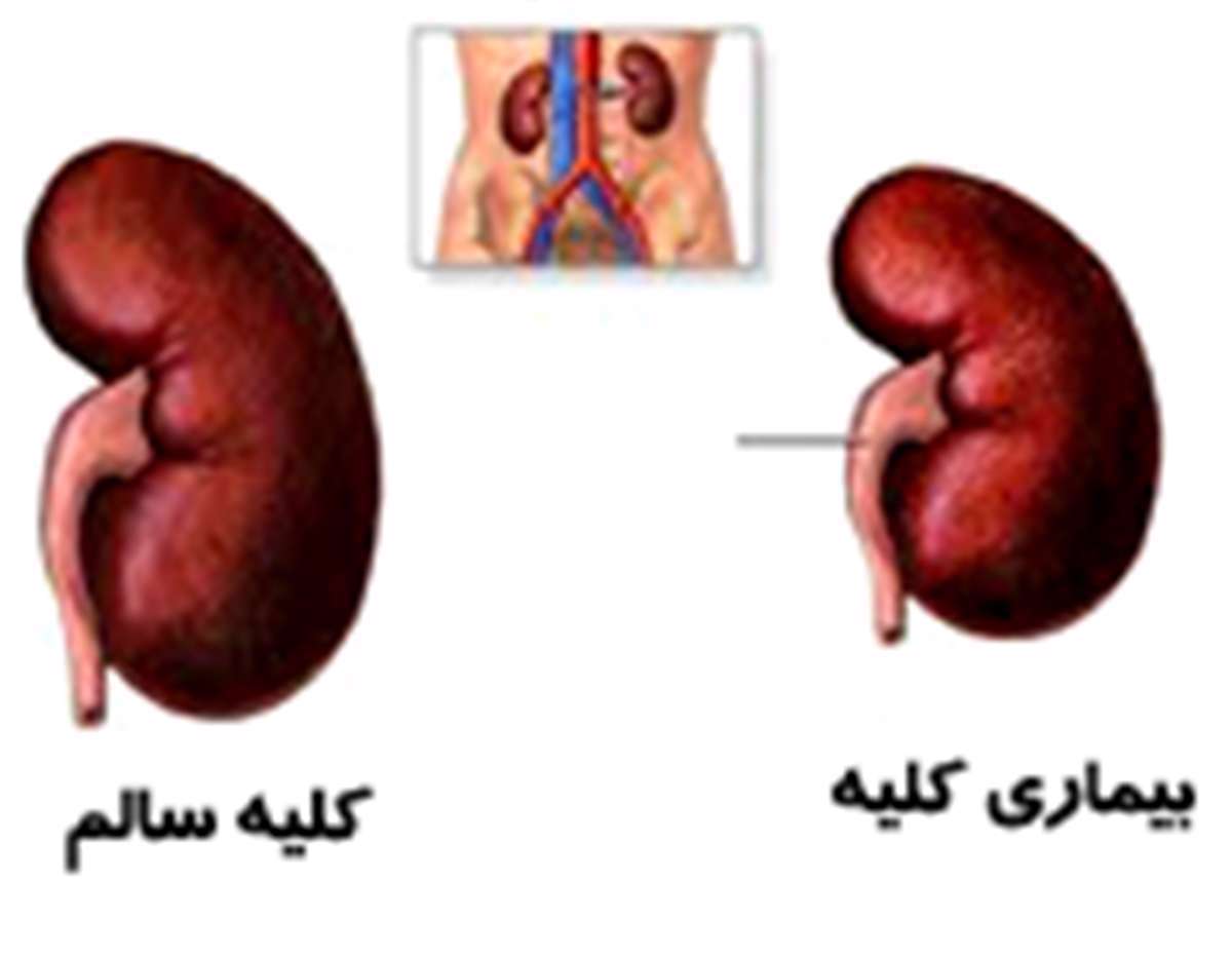 کلیه ها، کلیه سالم، بیماری کلیه، درمان نارسایی حاد کلیه،