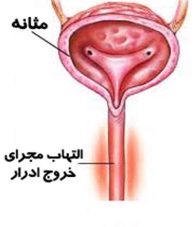 مثانه، التهاب مجرای خروج ادرار