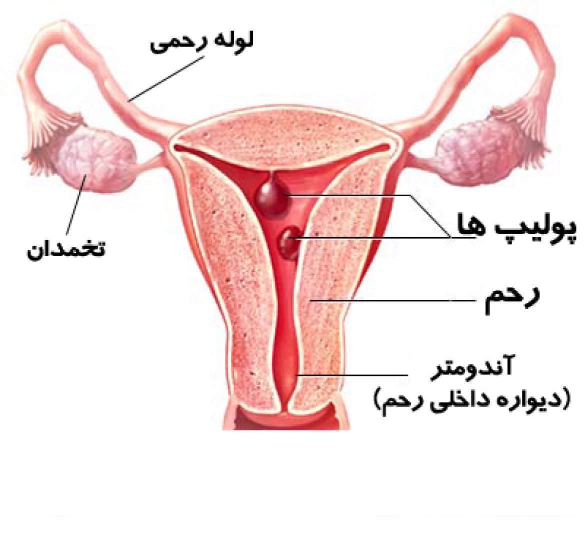 پولیپ های رحمی