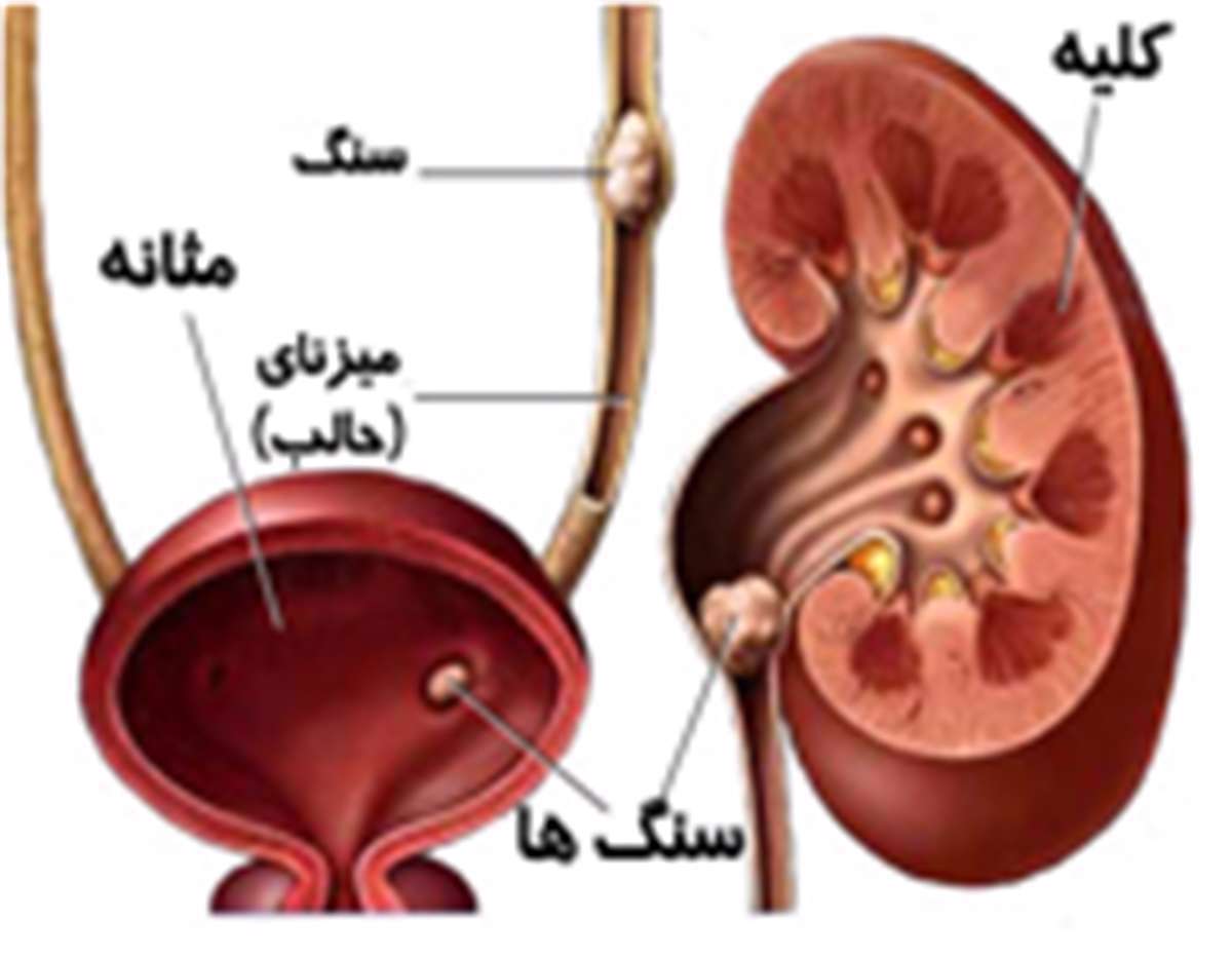 کلیه ها، عفونت دستگاه ادراری، دیسوری، کلیه ها، عفونت دستگاه ادراری، دیسوری،