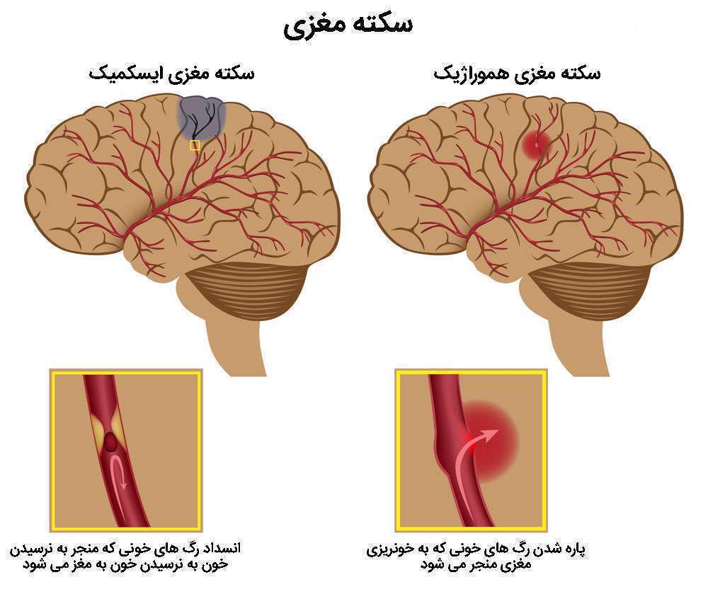 مغز، سکته مغزی، بینظمی ضربان قلب، سن بالا، عدم تحرک بدنی، آسیب عصبی، اختلال خونرسانی،