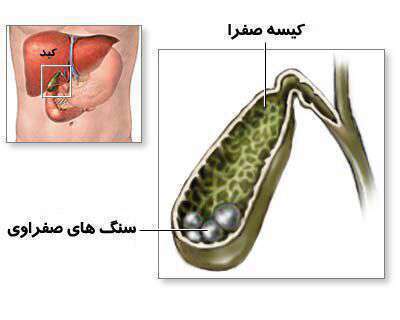 سنگهای صفراوی، التهاب کیسه صفرا، سنگ کیسه صفرا،