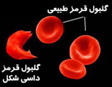 گلبول قرمز، گلبول قرمز داسی شکل، گلبول قرمز، گلبول قرمز داسی شکل،