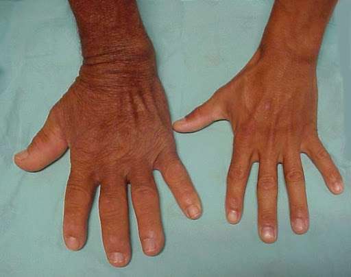 آکرومگالی؛ بزرگی غیرعادی دست و پا
