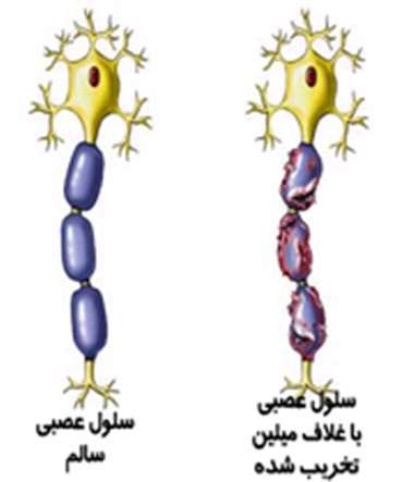 بیماری، ام اس، سلولها در ام اس،