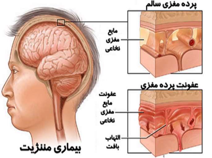 نشانه‌های مننژیت