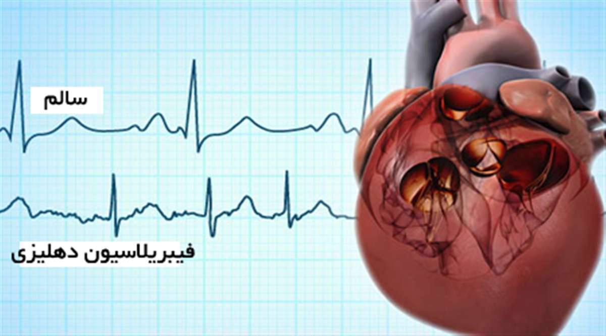 فیبریلاسیون دهلیزی، ضربان غیرطبیعی قلب، تپیدن سریع دهلیزها