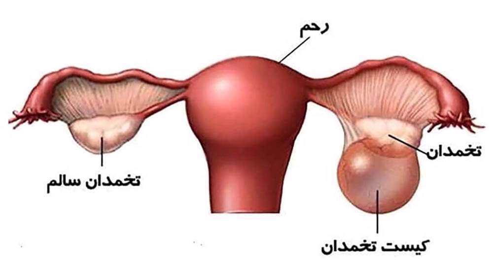 کیست تخمدان، تخمدان تنبل، 