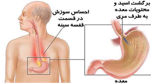 ریفلاکس معده، اسید معده، ترش کردن، برگشتن اسید معده،