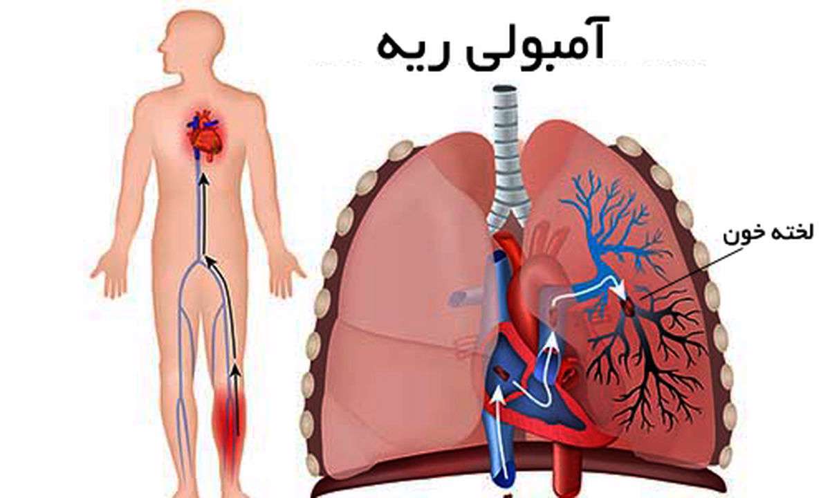 بیماری قلبی - آمبولی ریوی- ریه-