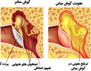 عفونت، گوش، گوش میانی،