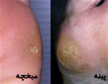 پینه پا، میخچه پا، مشکلات پوست پا،