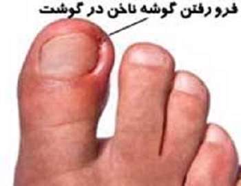 گوشه ناخن،