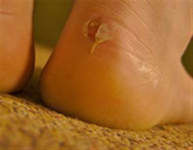 تاول پا، مشکلات پا، مشکلات پوست پا،