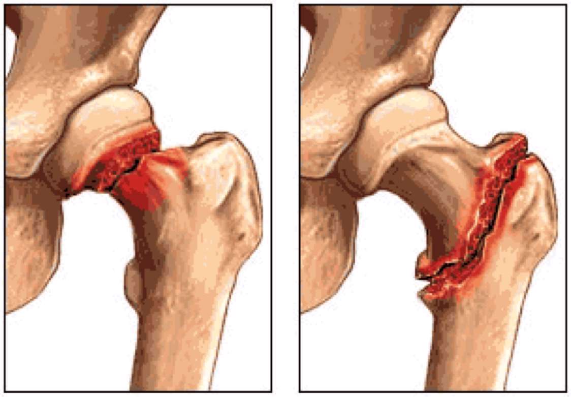  شکستگی‌ لگن، استخوان ران،