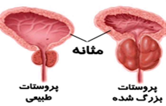 پروستات، مثانه، غده، 