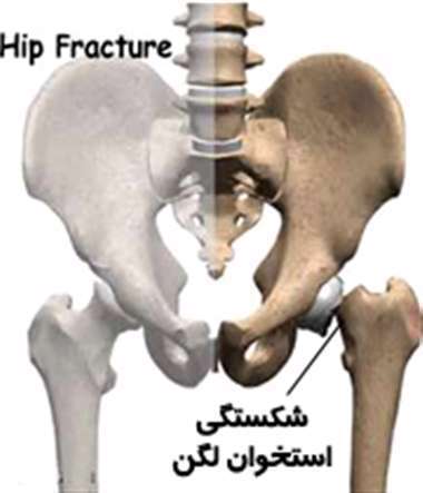 شکستگی لگن، شکستگی استخوان لگن،